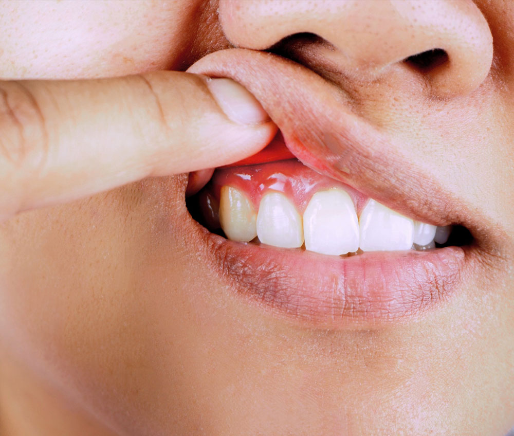 Die rote Ästhetik – unser Zahnfleisch als Indikator unserer Gesundheit